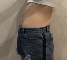 腰腹部吸脂手术的瘦身效果太好了