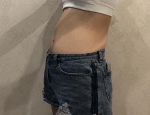 腰腹部吸脂手术1天