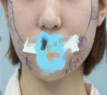 手术结束后就给我带了面罩