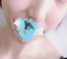 术后我一直都恢复的挺不错