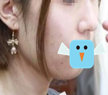 脂肪型的肉肉多需要吸脂了