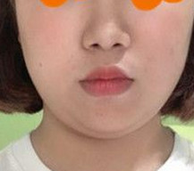 面部吸脂的效果就逐渐显现了