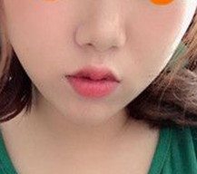 吸脂后面部轮廓线条更加流畅了