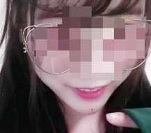 分享玻尿酸隆下巴手术变美的经历