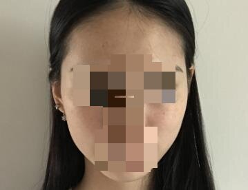 皮秒激光去除雀斑手术当天