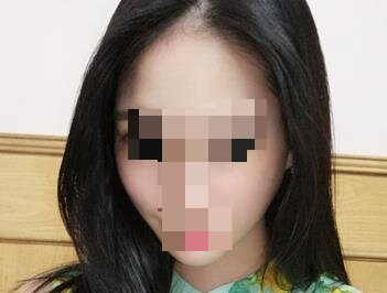 皮秒激光去除雀斑手术后15天