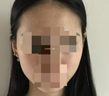 皮秒激光去除雀斑手术后脸蛋变漂亮啦