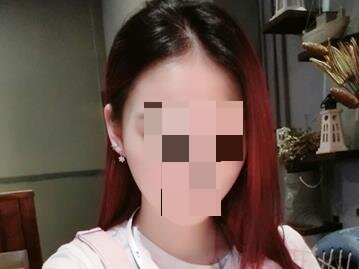 皮秒激光去除雀斑手术后30天