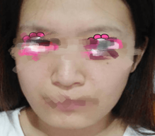 面部吸脂后，脸都看起来小了一圈