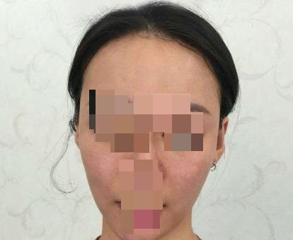 光子嫩肤手术后5天