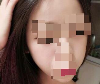 自体脂肪丰苹果肌手术当天