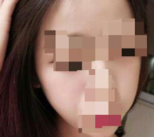 分享自体脂肪丰苹果肌手术变美的经历