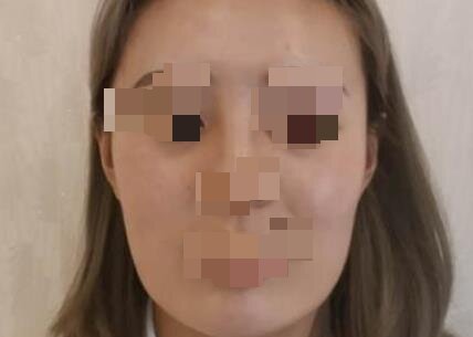 双眼皮+隆鼻+下颌角磨骨手术当天