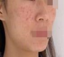 皮肤差，看看热玛吉的效果怎么样