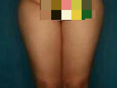 想要身材好看,可以做大腿吸脂手术
