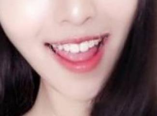 冷光牙齿美白已经一个月