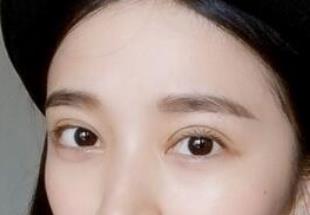 双眼皮手术后一个月