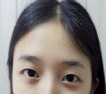 双眼皮手术让我的眼睛美丽迷人