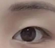 双眼皮手术
