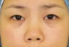 双眼皮点缀出双眼美感