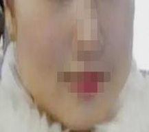 肥肥的脸蛋受不了了，瘦脸去咯