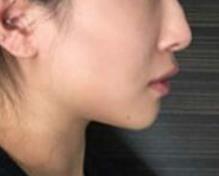 鼻子整形手术后20天