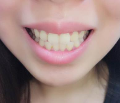 牙齿冷光美白手术当天的情况