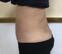 腰腹吸脂手术的效果非常好