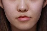面颊凹陷脸型不美观