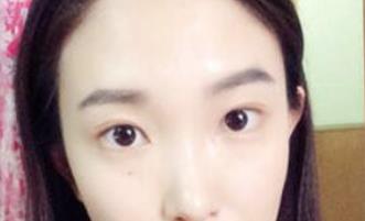 双眼皮修复手术当天