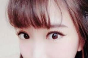 双眼皮修复手术后一个半月