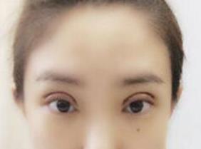 双眼皮修复手术后15天