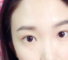 找专业医院做双眼皮修复手术效果很不错