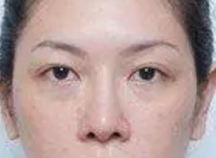 眼袋出现非常显老