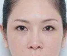 终于摆脱眼袋困扰