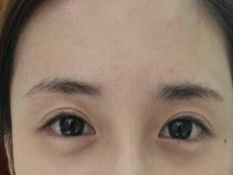 切开双眼皮手术当天