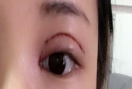 切开双眼皮手术后10天