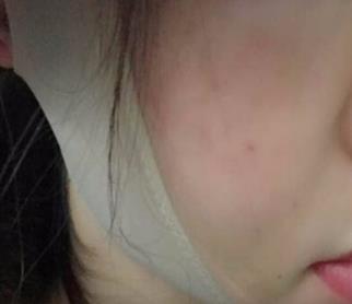 自体脂肪丰苹果肌手术后10天