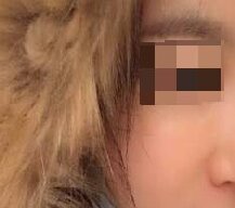 做自体脂肪丰苹果肌后我变得更加漂亮了