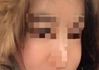自体脂肪丰苹果肌手术当天
