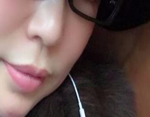 自体脂肪丰苹果肌手术后1个月