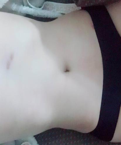 腰部吸脂手术后20多天