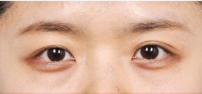摆脱眼袋塑造美眼 整体形象大大提升