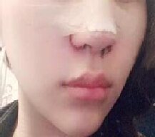 鼻部综合整形手术很大提升了鼻部的美观