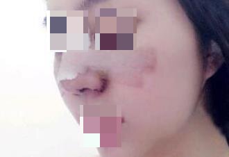 鼻部综合整形手术后半个月