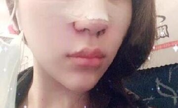 鼻部综合整形手术后3天