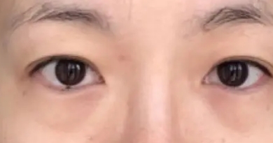 眼袋明显影响形象