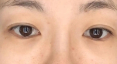 去除眼袋效果很好