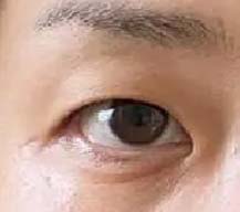 想割双眼皮