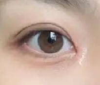 双眼皮手术